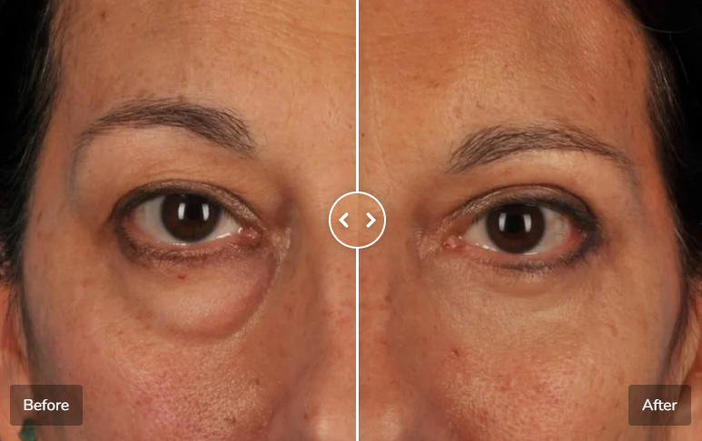 Red Light Eye Massager for Puffy, Tired Eyes