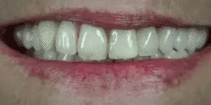 NovaBright Custom Fit Snap-On Veneers, Removable Complete Set for Upper and Lower Teeth