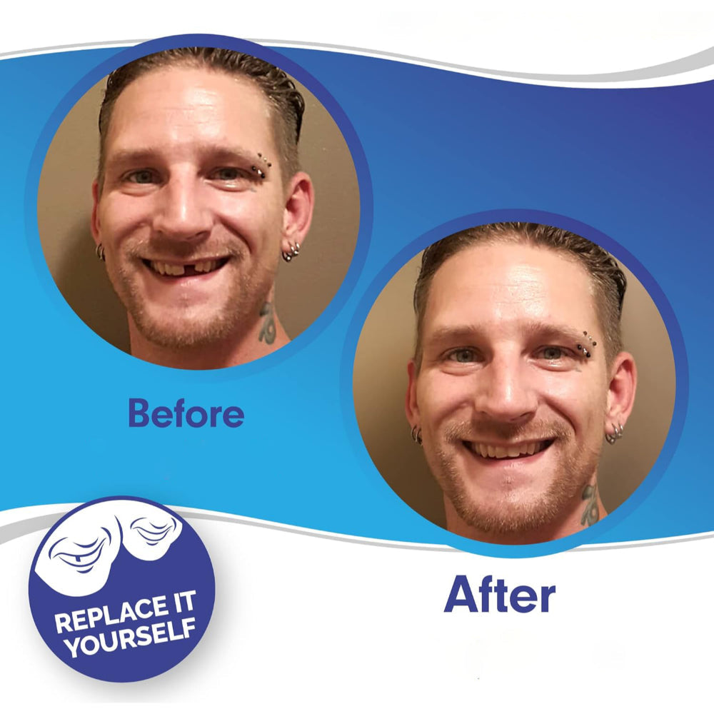 طقم أغطية أسنان بتصميم قشور - واقٍ تجميلي أمامي من قطعتين