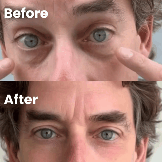 Eye Wellness Device for Puffiness, Dark Circles and Daily Refresh